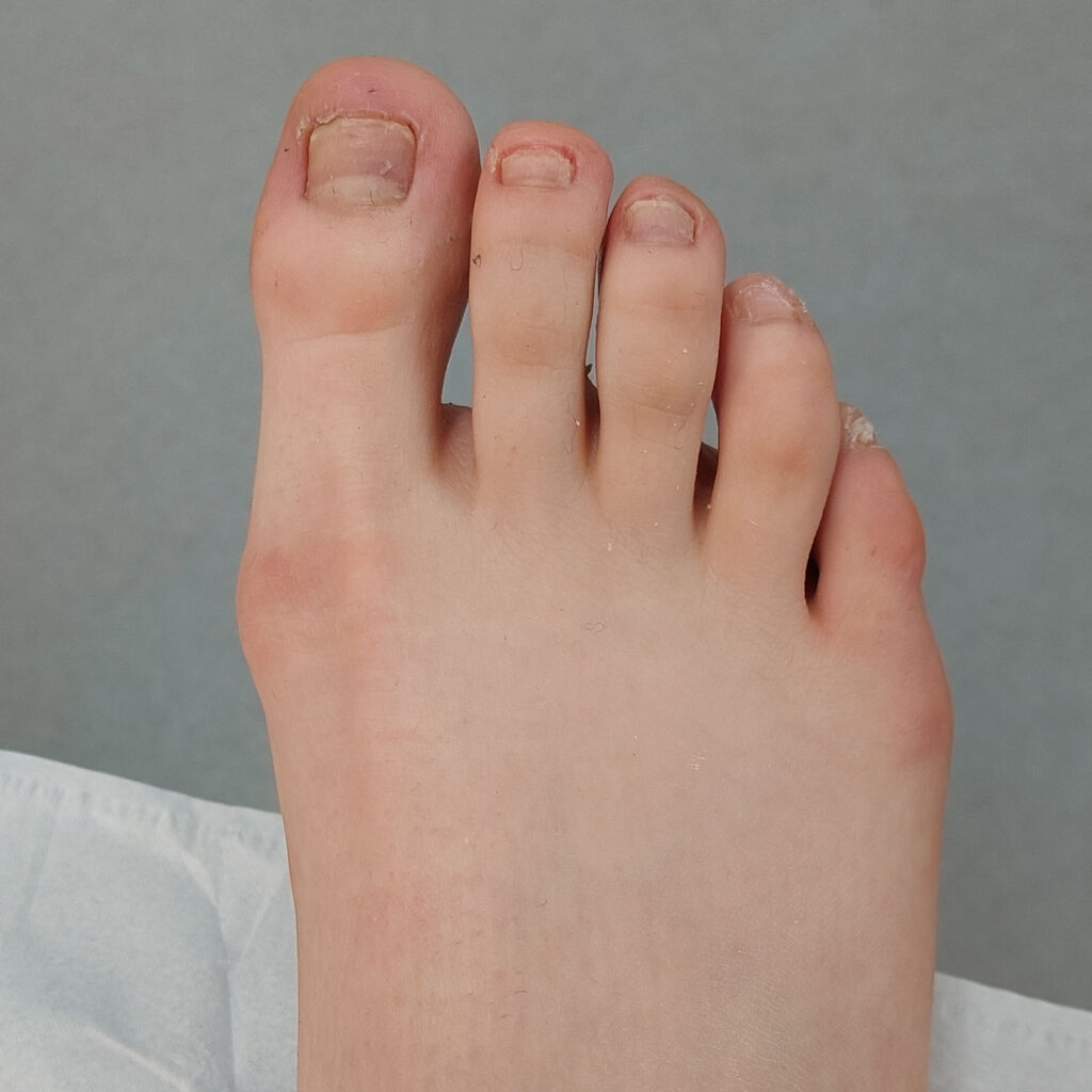 After Fungal nail infection treatment