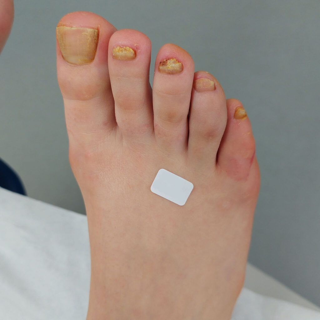 Before Fungal nail infection treatment