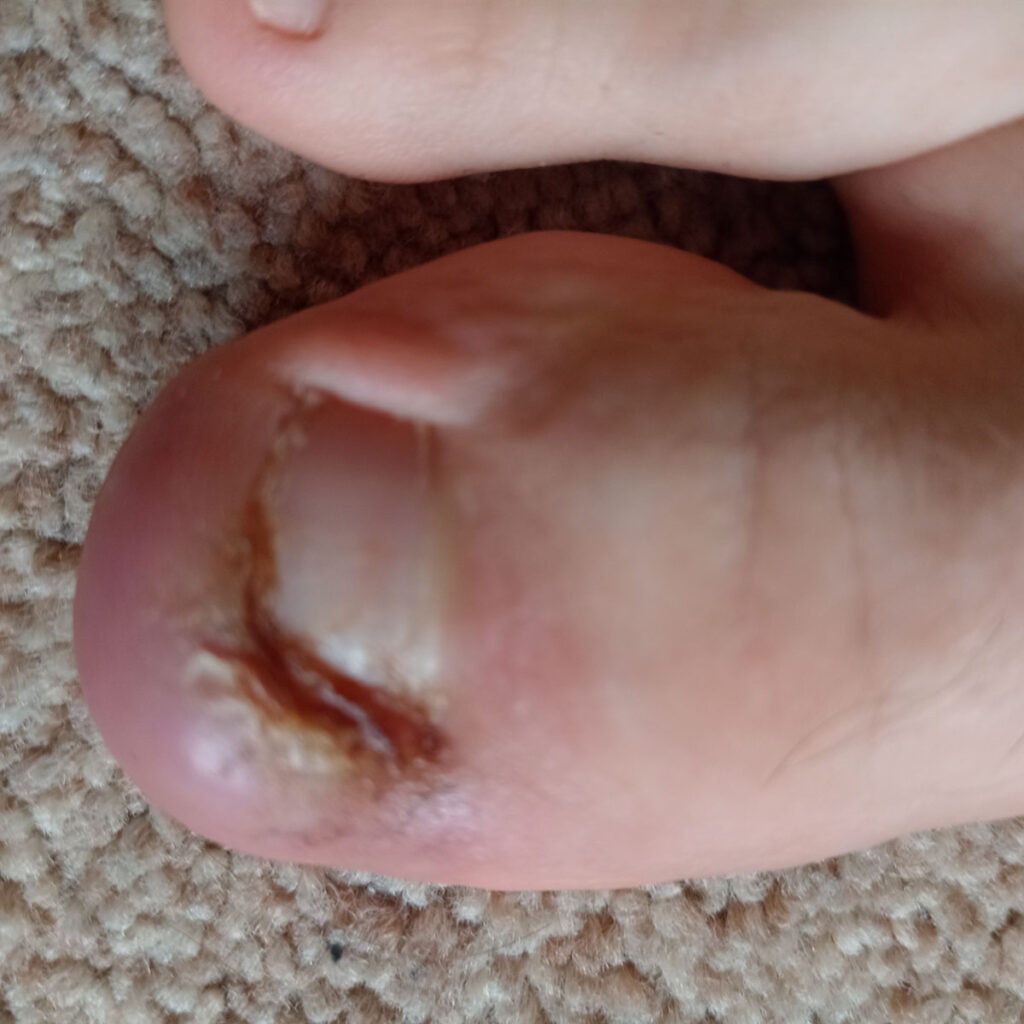 Before Fungal nail infection treatment