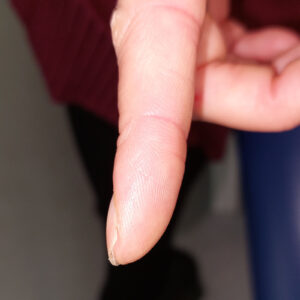 Finger wart after treatment