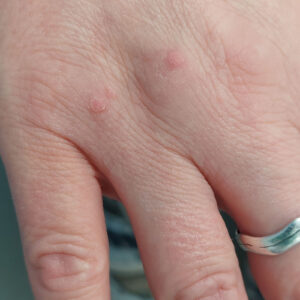 Hand warts before treatment